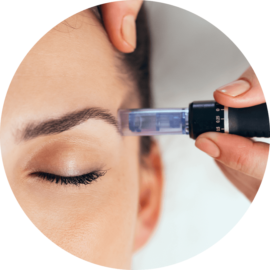 microneedling procedure